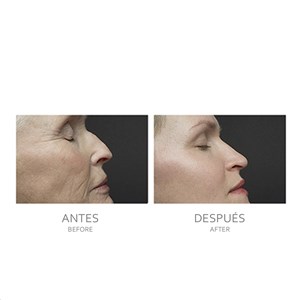 Instrument de soin de la peau 4 en 1 : ems, radiofréquence, ultrasons.