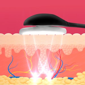 Dispositif ems de stimulation électrique faciale 105y avec télécommande.