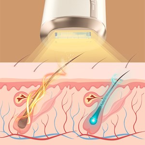 Épilateur ipl à lumière pulsée. 5 niveaux de puissance et tirs de flash.
