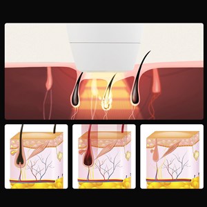 Instrument de dépilation avec lumière de couleur. Tube de lampe en quartz.