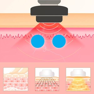 Appareil de massage myoélectrique de rajeunissement zeus 7,4v